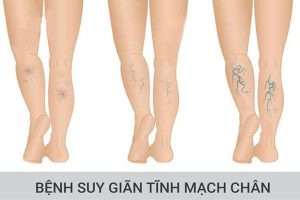 dau hieu bi suy gian tinh mach chan